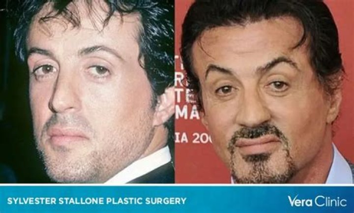 Everything There is to Know About Sylvester Stallone’s Plastic Surgery